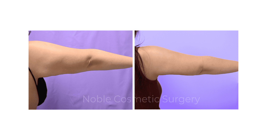ARM-LIFT-CASE-19182 | Before and After Brachioplasty 4