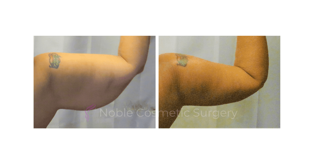 ARM-LIFT-CASE-19050 | Before and After Brachioplasty 4