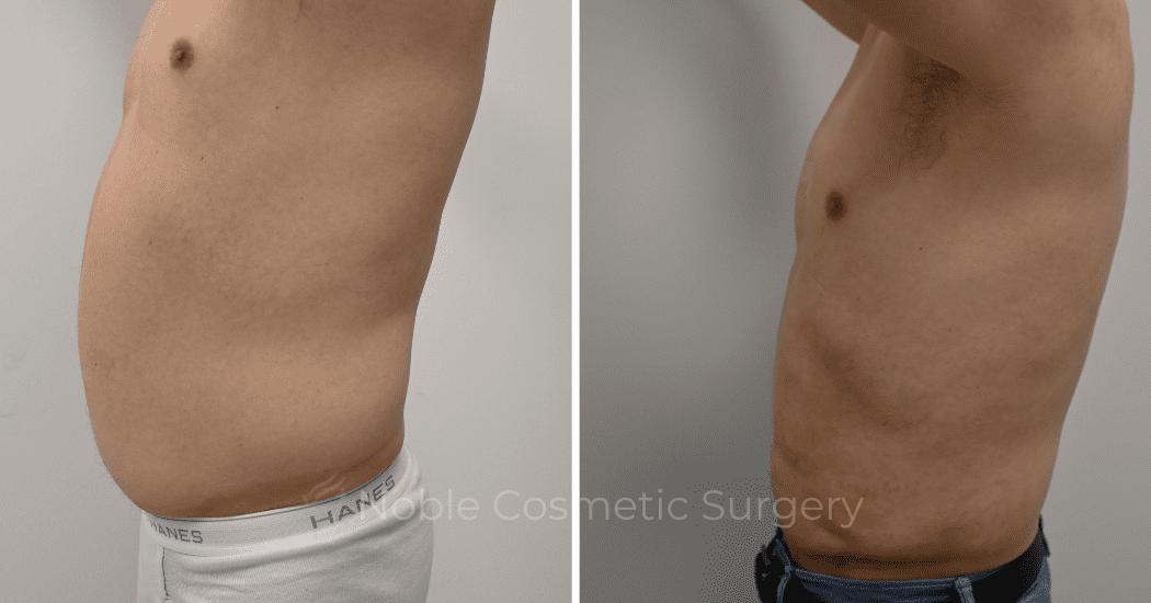 LIPOSUCTION-ABDOMEN-CASE-12252 | Before and After Male Liposuction 5