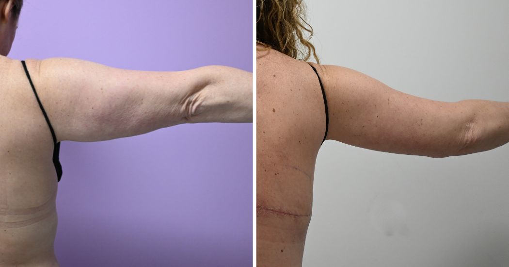 Case--20309 | Before and After Brachioplasty 6