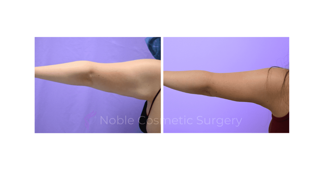 ARM-LIFT-CASE-19182 | Before and After Brachioplasty 3