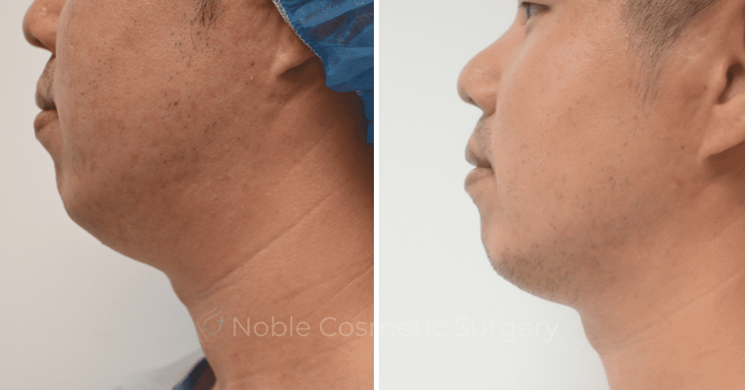SUBMENTAL-LIPOSUCTION-CASE-10214 | Before and After Chin Liposuction 4