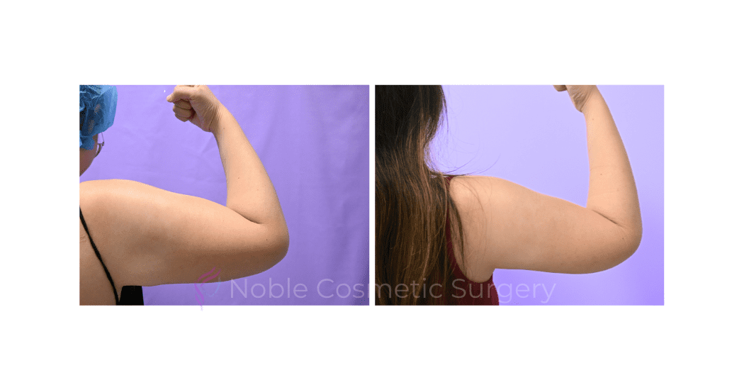 ARM-LIFT-CASE-19182 | Before and After Brachioplasty 7