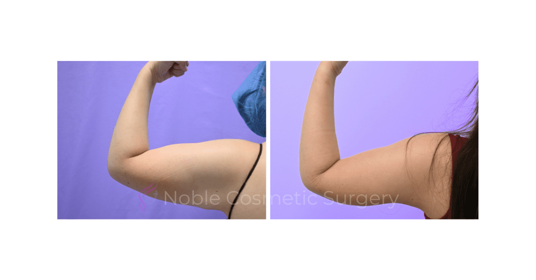 ARM-LIFT-CASE-19182 | Before and After Brachioplasty 8