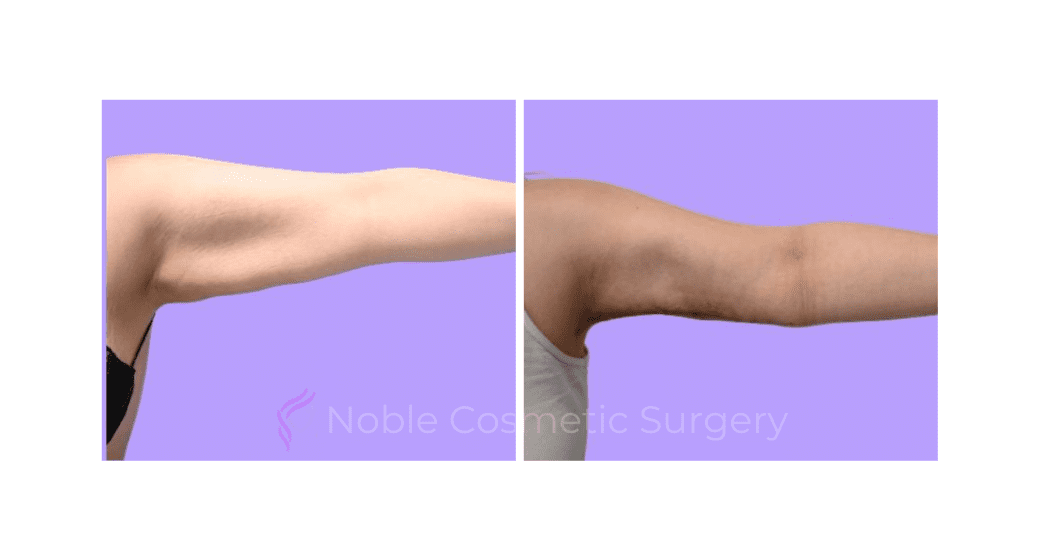 ARM-LIFT-CASE-19182 | Before and After Brachioplasty