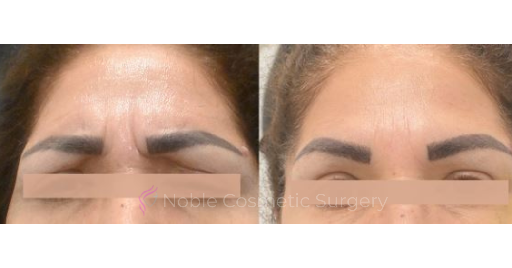 BOTOX-CASE-10011 | Before and After BOTOX® Cosmetic