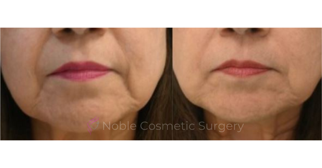 BOTOX-CASE-10012 | Before and After BOTOX® Cosmetic