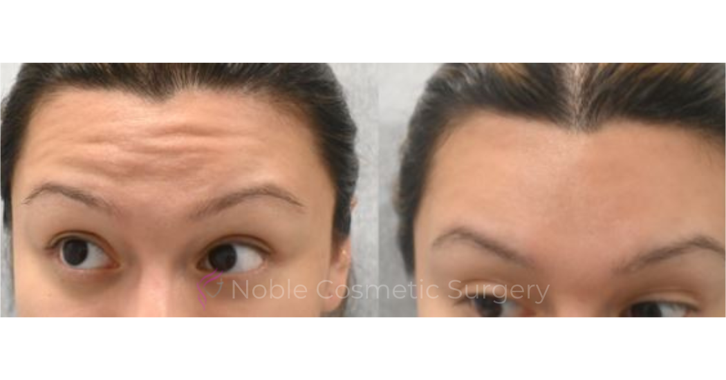 BOTOX-CASE-10013 | Before and After BOTOX® Cosmetic