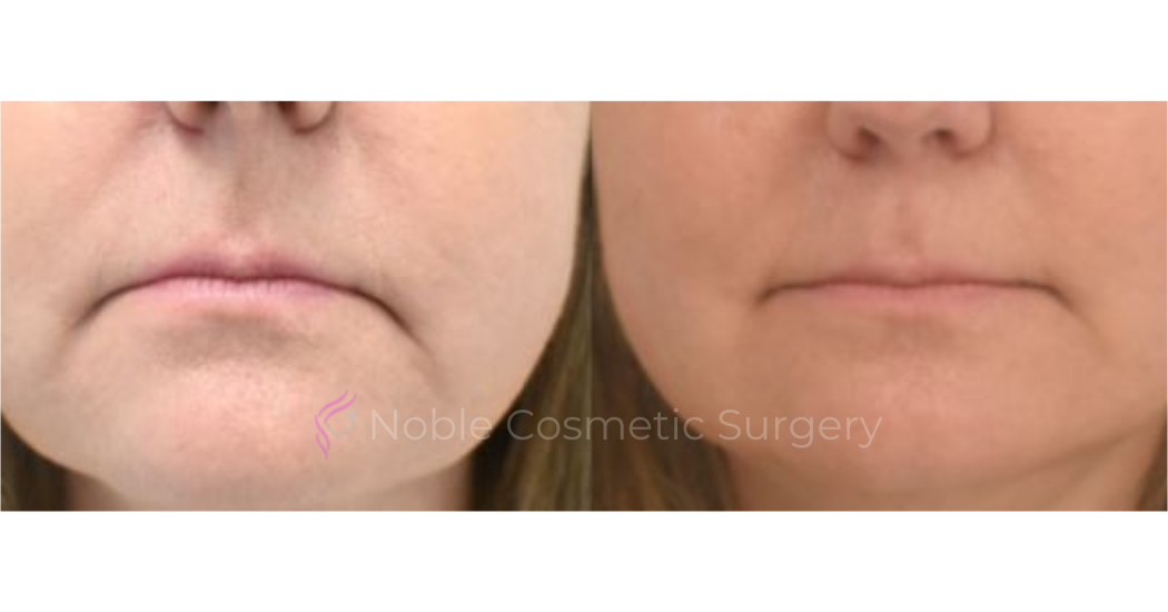 BOTOX-CASE-10015 | Before and After BOTOX® Cosmetic