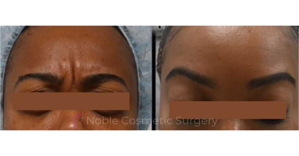 BOTOX-CASE-10016 | Before and After BOTOX® Cosmetic