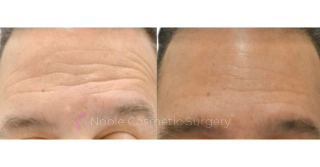 BOTOX-CASE-10018 | Before and After BOTOX® Cosmetic