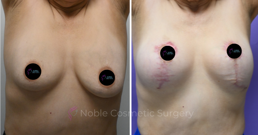 BREAST-AUGMENTATION--WITH-LIFT--CASE-11535 | Before and After Breast Augmentation with Lift