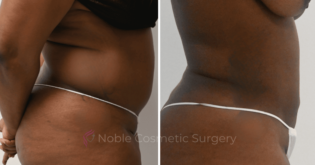 LIPOSUCTION-ABDOMEN-CASE-10873 | Before and After Liposuction 2