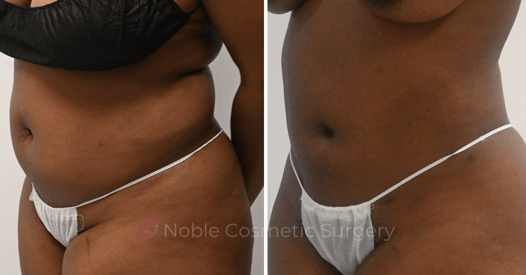 LIPOSUCTION-ABDOMEN-CASE-10873 | Before and After Liposuction 3