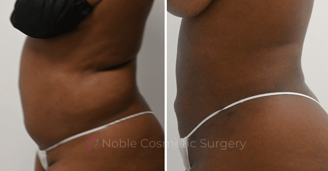 LIPOSUCTION-ABDOMEN-CASE-10873 | Before and After Liposuction 4