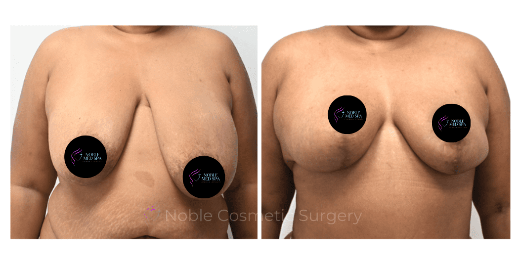 BREAST-REDUCTION-CASE-19222 | Before and After Breast Reduction