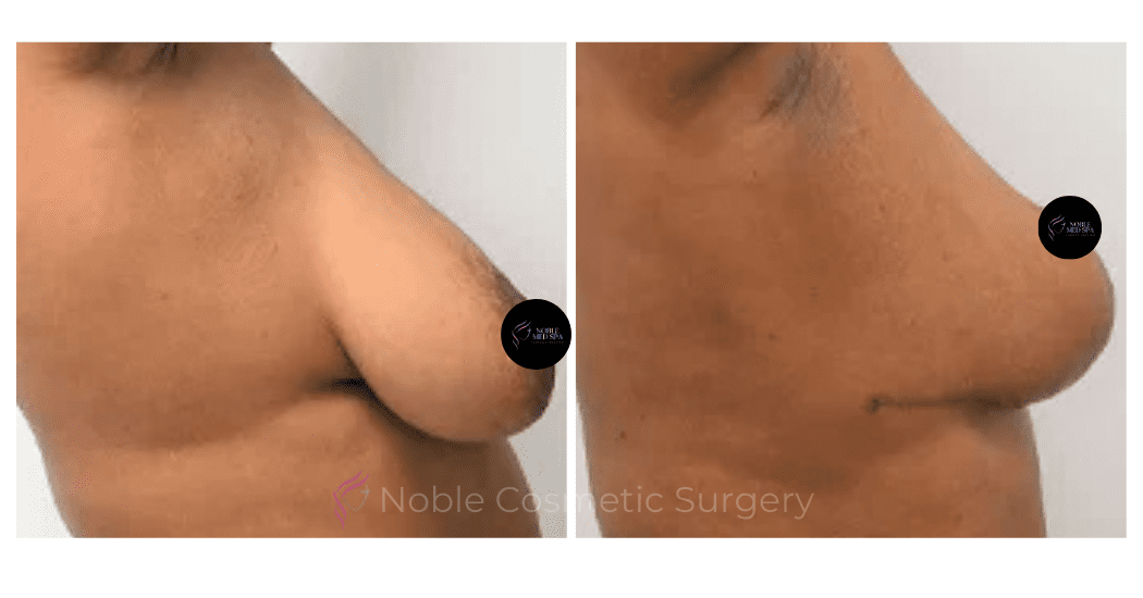 BREAST-REDUCTION-CASE-19222 | Before and After Breast Reduction 2
