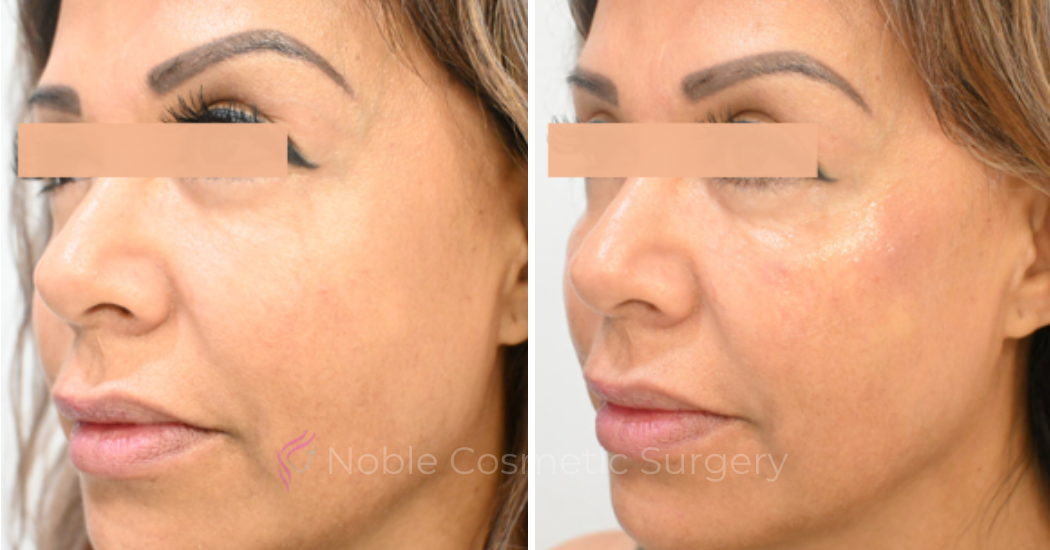 RF-MICRONEEDLING--CASE-00080 | Before and After RF Microneedling