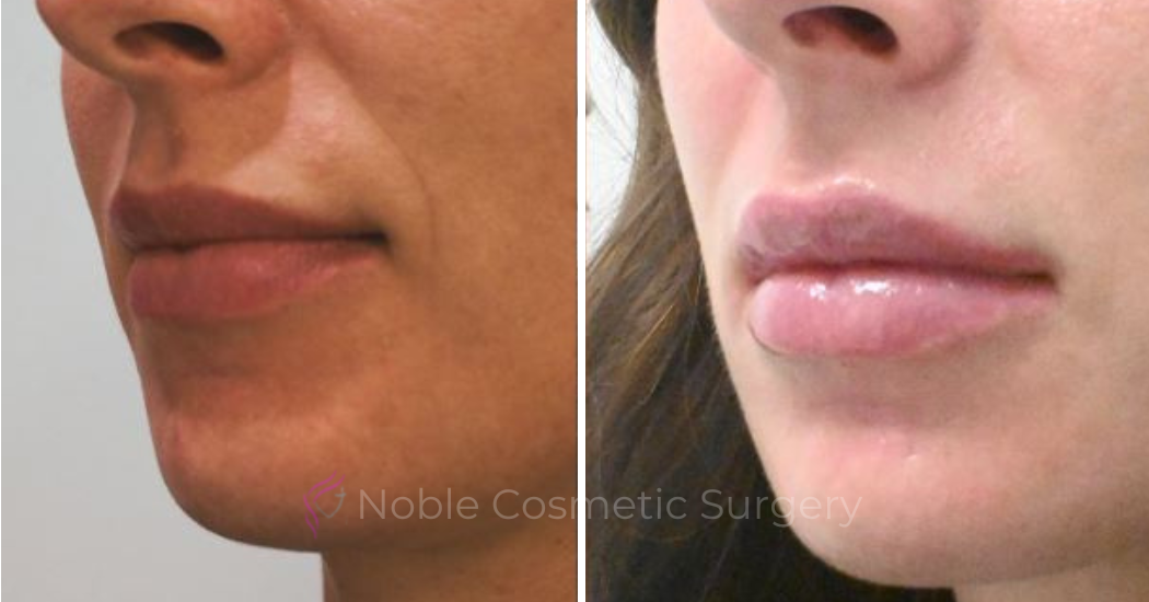 DERMAL-FILLERS-CASE-00260 | Before and After Dermal Fillers