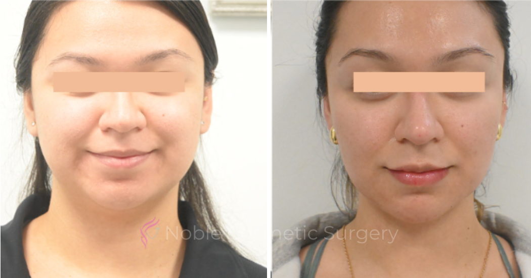LIQUID-RHINOPLASTY-CASE-10006 | Before and After Liquid Rhinoplasty