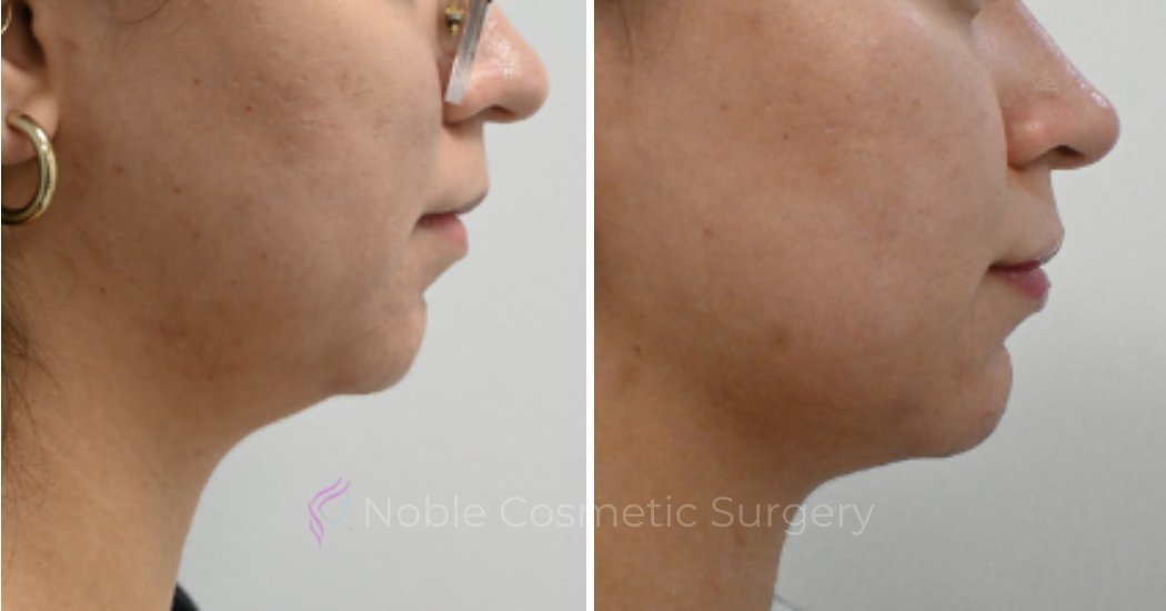 LIQUID-RHINOPLASTY-CASE-10005 | Before and After Liquid Rhinoplasty