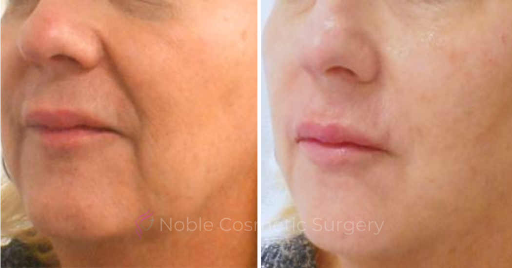 DERMAL-FILLERS-CASE-00262 | Before and After Dermal Fillers