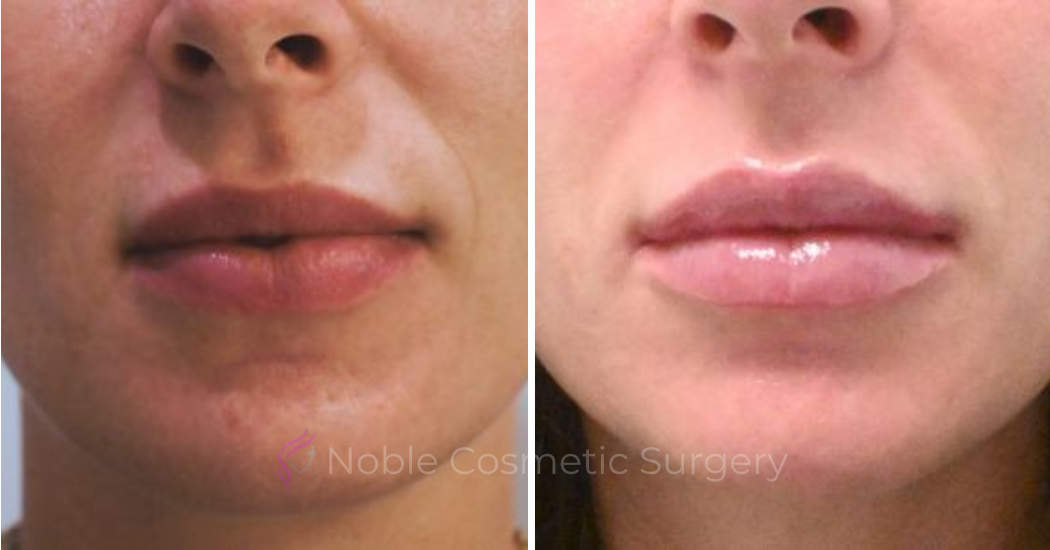 DERMAL-FILLERS-CASE-00263 | Before and After Dermal Fillers