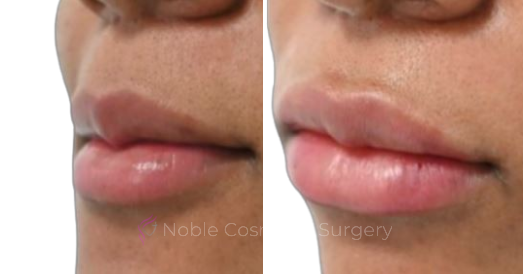 DERMAL-FILLERS-CASE-00264 | Before and After Dermal Fillers
