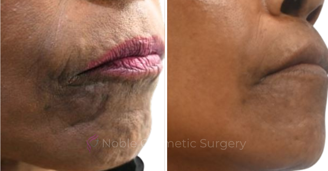 RF-MICRONEEDLING-CASE-00070 | Before and After RF Microneedling