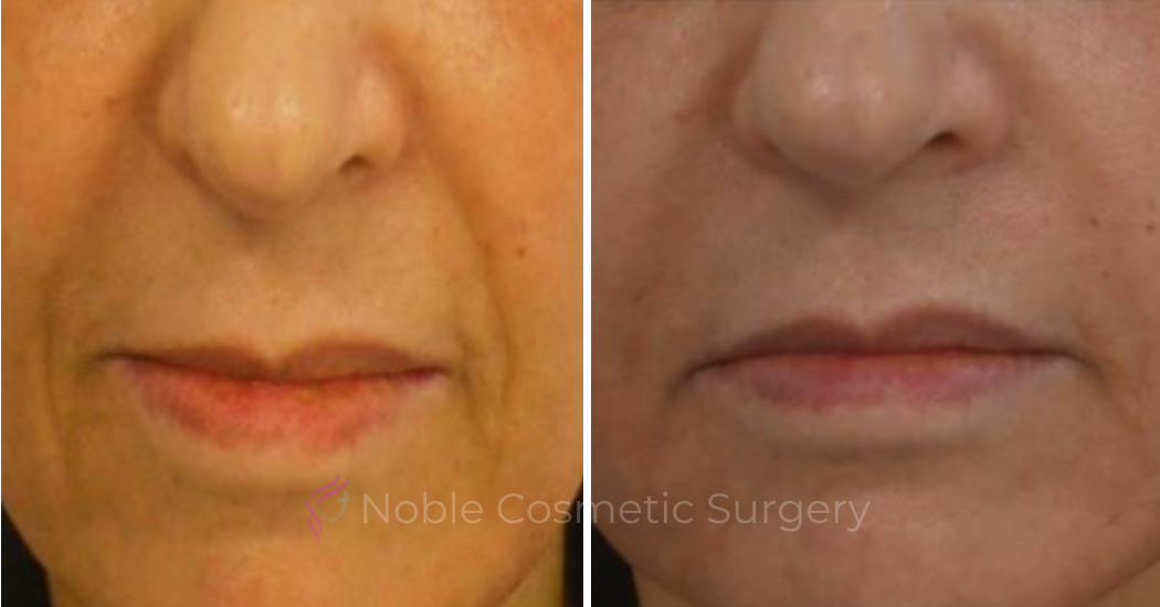 DERMAL-FILLERS-CASE-00266 | Before and After Dermal Fillers