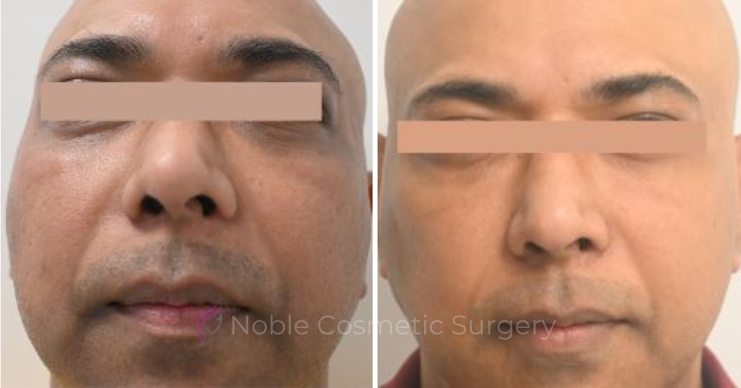 LIQUID-RHINOPLASTY-CASE-10003 | Before and After Liquid Rhinoplasty