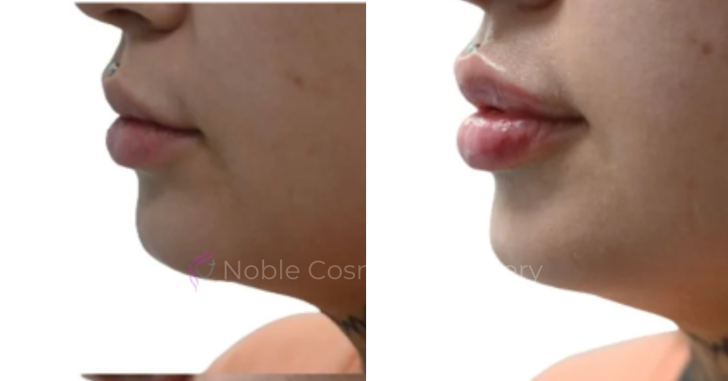 DERMAL-FILLERS-CASE-00267 | Before and After Dermal Fillers