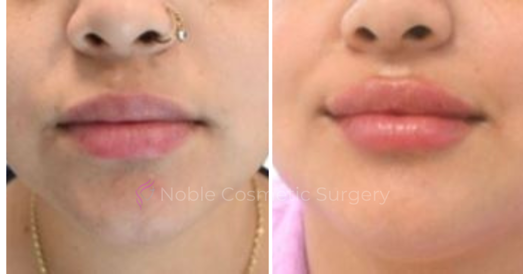 DERMAL-FILLERS-CASE-00268 | Before and After Dermal Fillers
