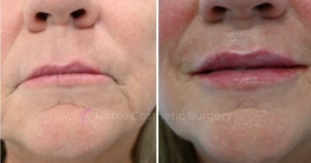 DERMAL-FILLERS-CASE-00269 | Before and After Dermal Fillers