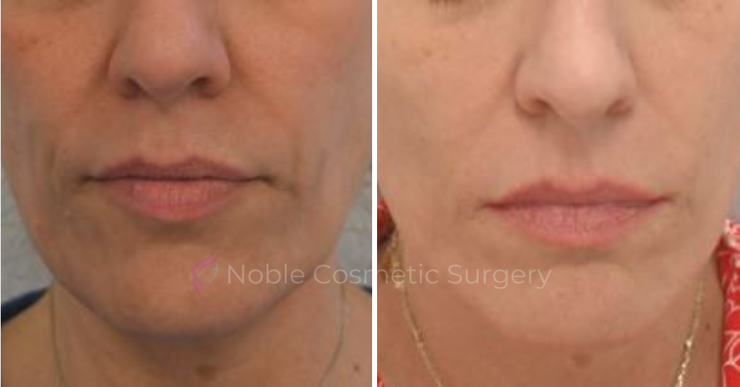 RF-MICRONEEDLING--CASE-00060 | Before and After RF Microneedling
