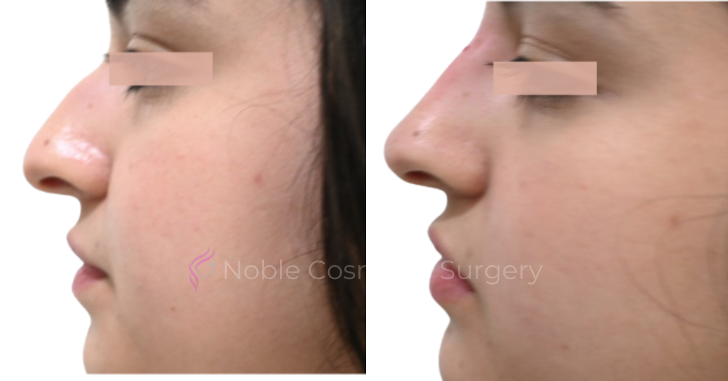 LIQUID-RHINOPLASTY-CASE-10002 | Before and After Liquid Rhinoplasty