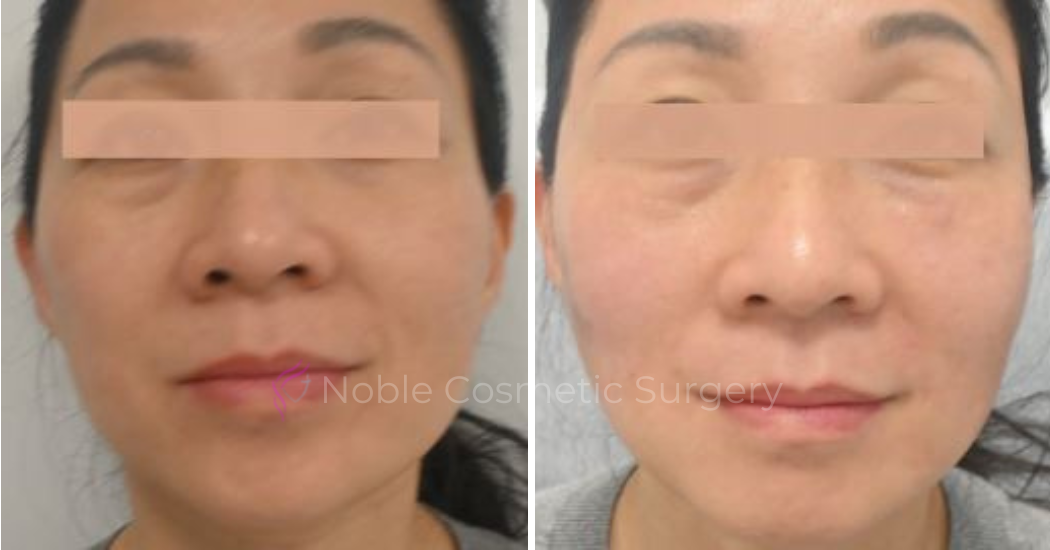 RF-MICRONEEDLING-CASE-00040 | Before and After RF Microneedling