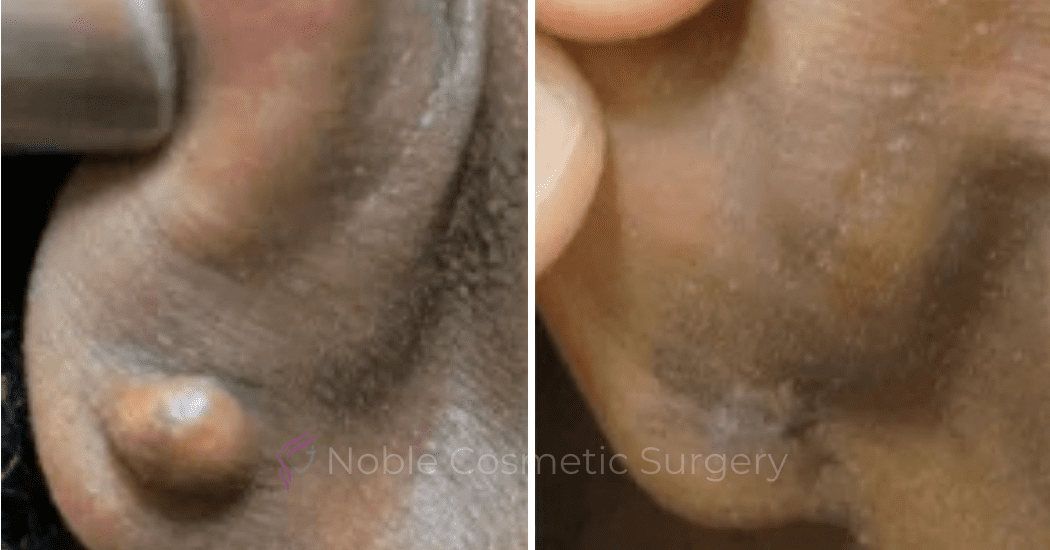 Earlobe-Repair-Case-20251 | Before and After Earlobe Repair