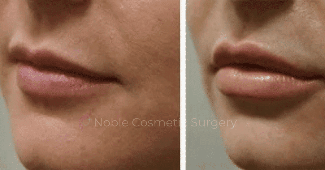 DERMAL-FILLERS-CASE-00257 | Before and After Dermal Fillers
