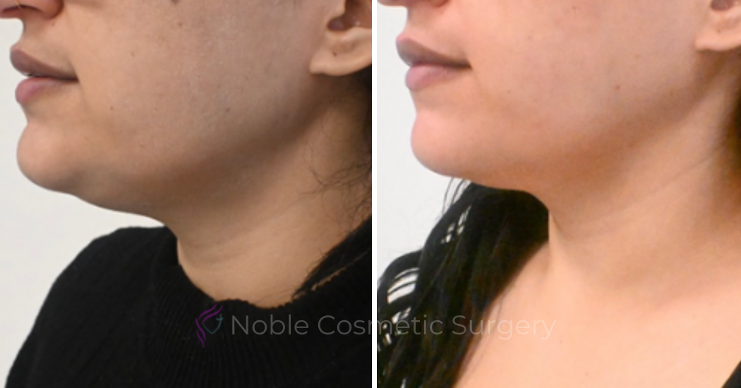 KYBELLA-CASE-00100 | Before and After Kybella