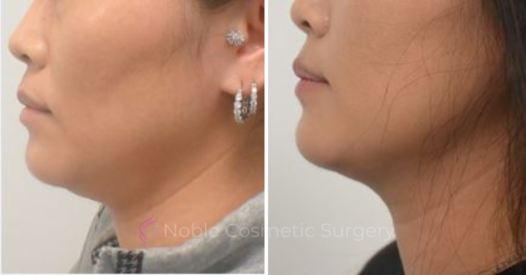 KYBELLA-CASE-00300 | Before and After Kybella