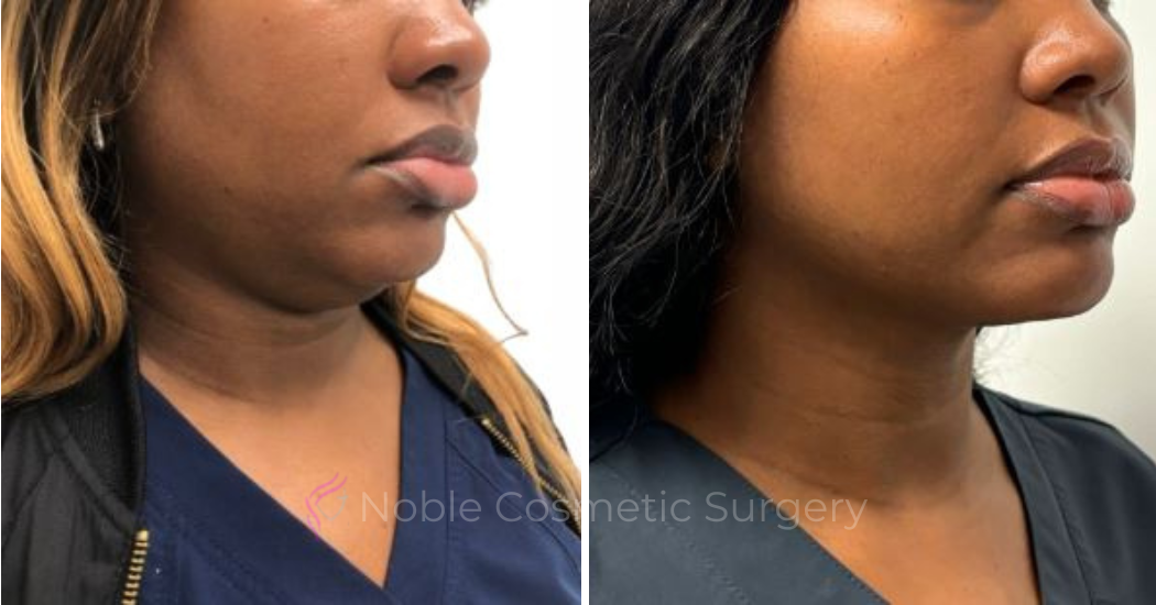 KYBELLA-CASE-00400 | Before and After Kybella