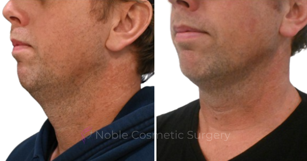 KYBELLA-CASE-00500 | Before and After Kybella