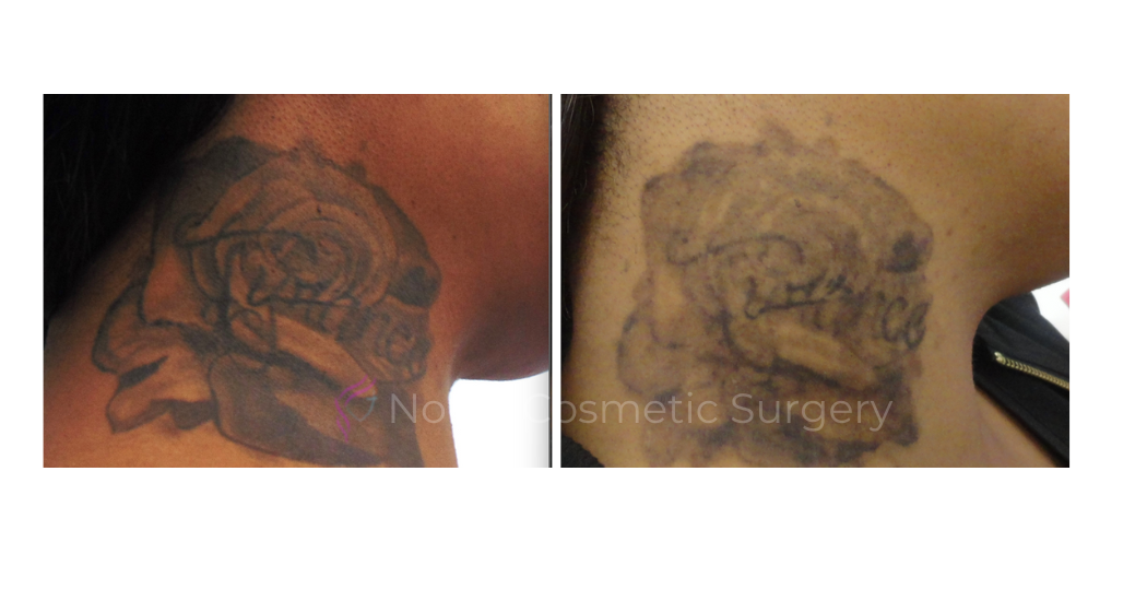 LASER-TATTOO-REMOVAL-CASE-00002 | Before and After Laser Tattoo Removal