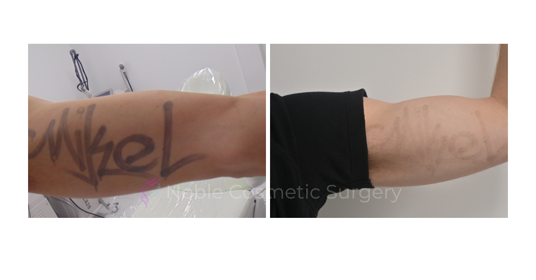 LASER-TATTOO-REMOVAL-CASE-00004 | Before and After Laser Tattoo Removal