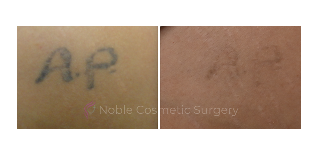 LASER-TATTOO-REMOVAL-CASE-00003 | Before and After Laser Tattoo Removal