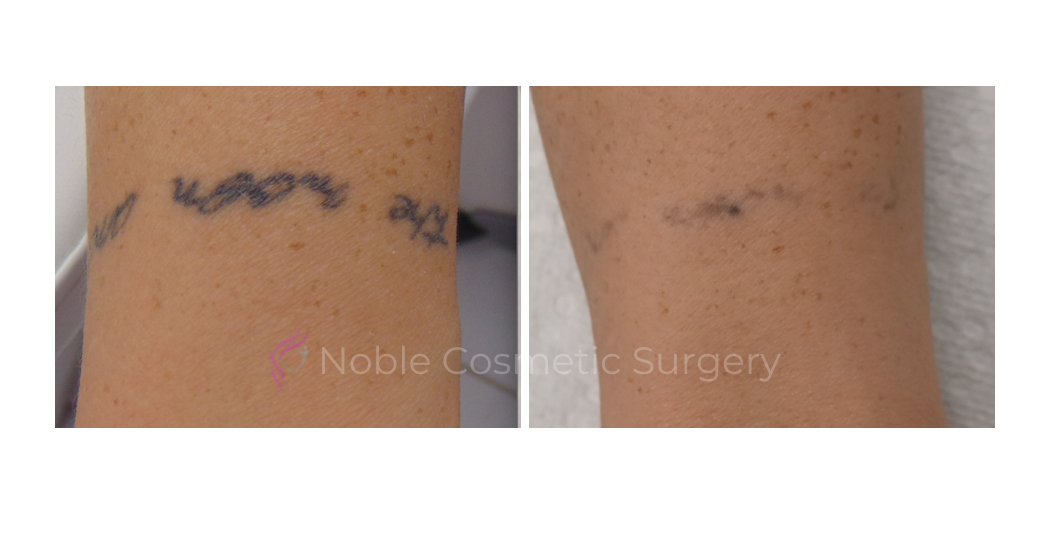LASER-TATTOO-REMOVAL-CASE-00005 | Before and After Laser Tattoo Removal