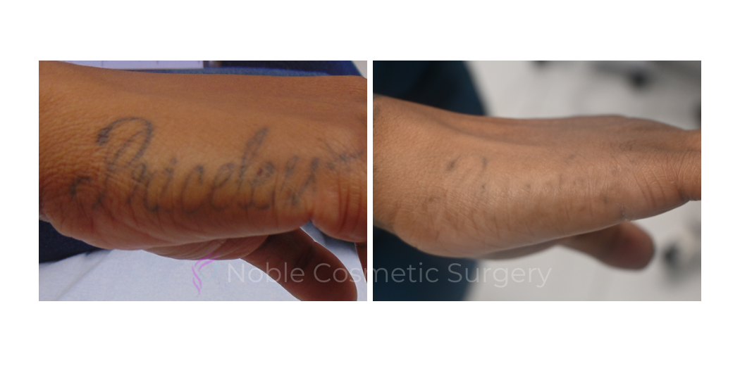 LASER-TATTOO-REMOVAL-CASE-00006 | Before and After Laser Tattoo Removal