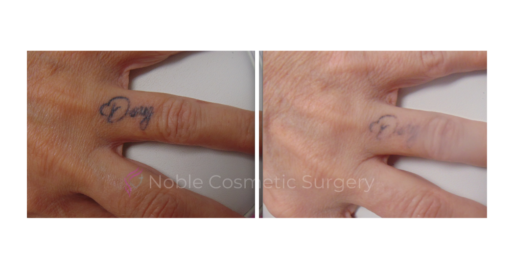 LASER-TATTOO-REMOVAL-CASE-00007 | Before and After Laser Tattoo Removal
