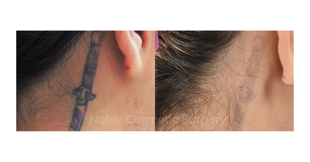 LASER-TATTOO-REMOVAL-CASE-00008 | Before and After Laser Tattoo Removal